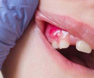 Dental Abscess