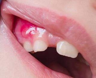 Abscess Associated with Dental Infection