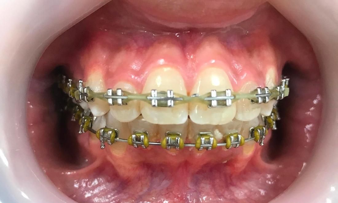 Braces and Invisalign - After