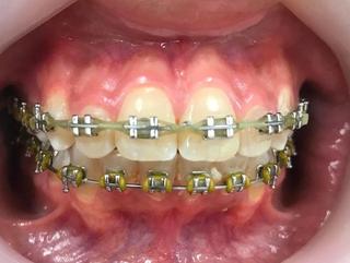 Braces and Invisalign - After
