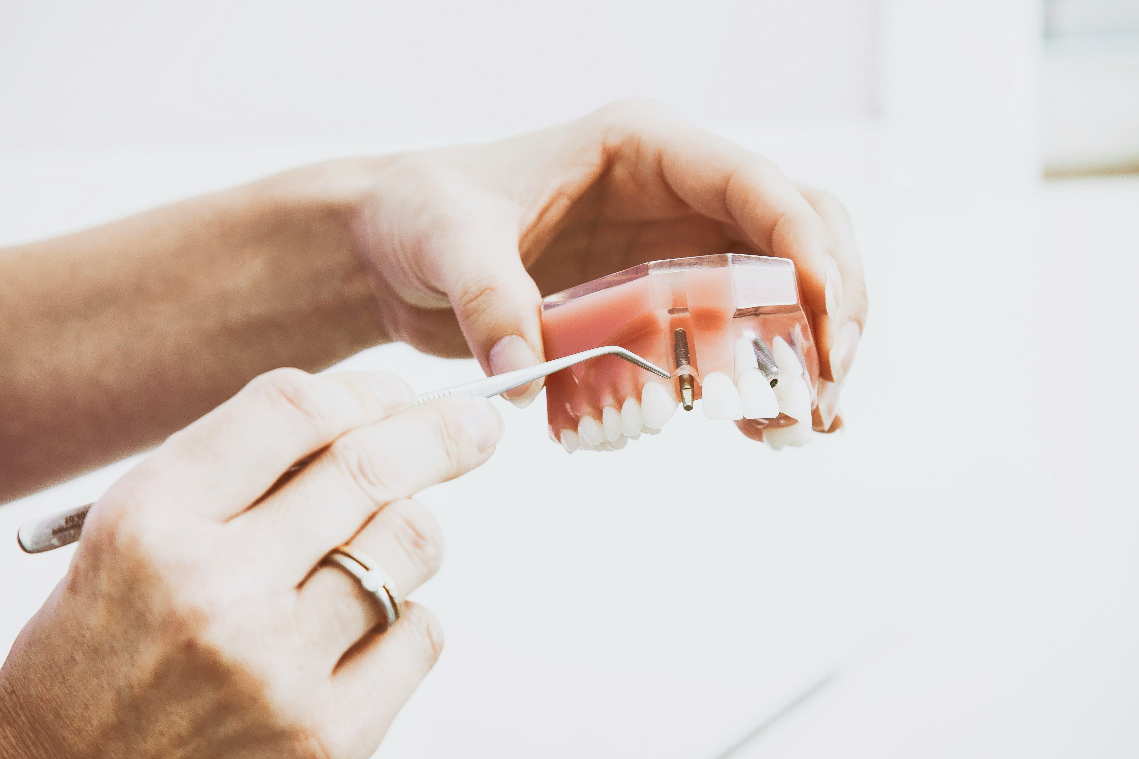Abutment Placement