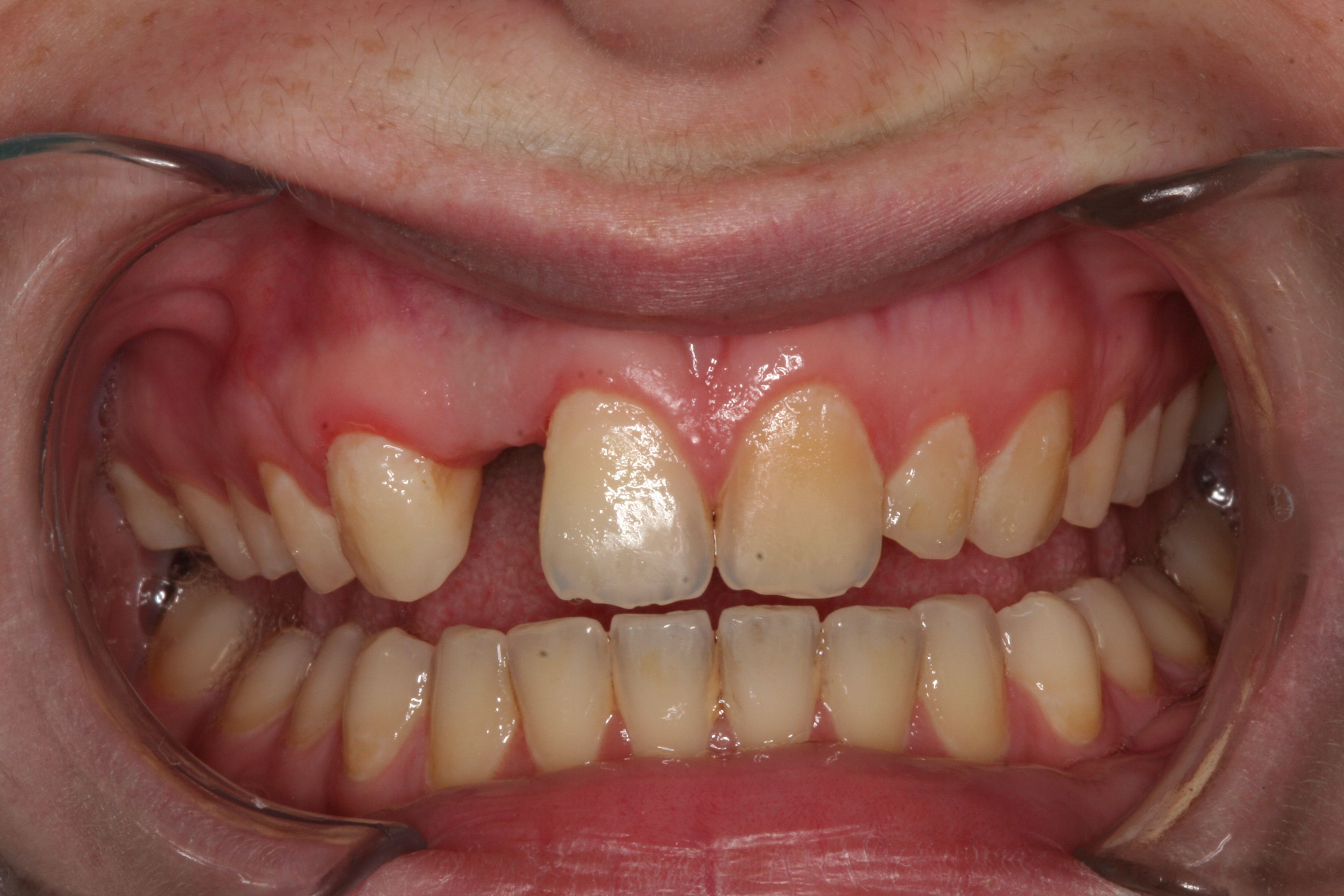  Front Tooth Implant and Veneers before