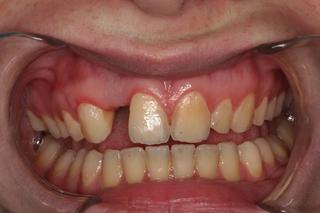 Front Tooth Implant and Veneers before