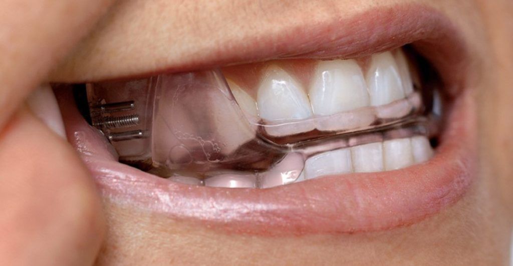 Treatment — Custom Oral Appliances