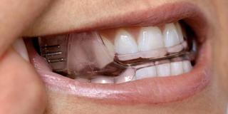 Treatment — Custom Oral Appliances