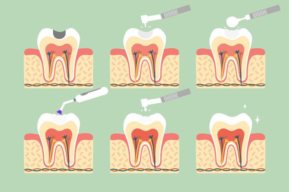 The Process Of Getting White Fillings