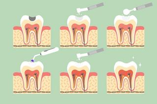 The Process Of Getting White Fillings