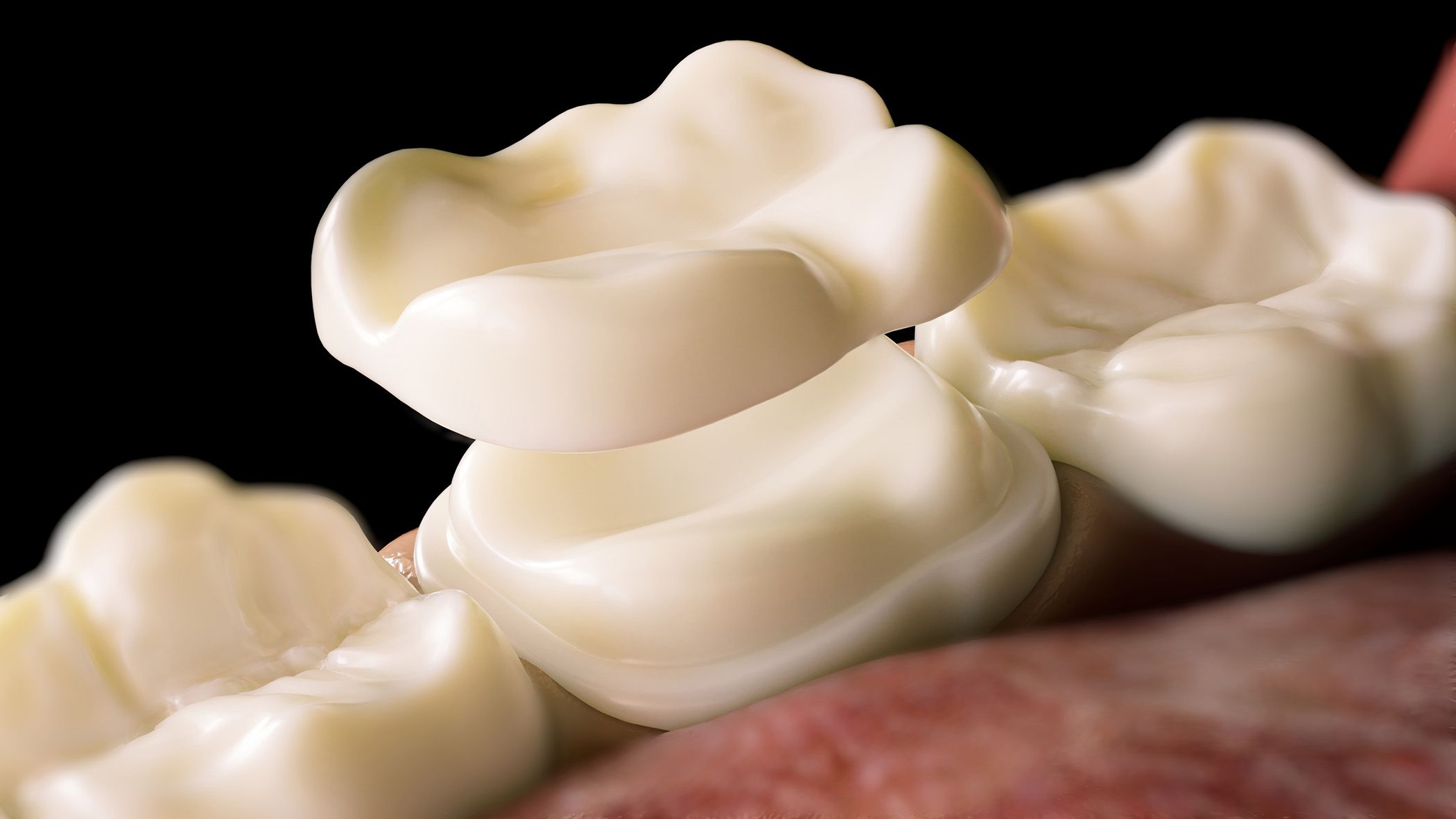 Close up image of a ceramic onlay that is being placed on a tooth.