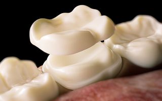 Close up image of a ceramic onlay that is being placed on a tooth.