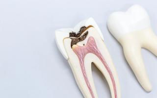 Root Canal Treatment in Carnegie - Hero
