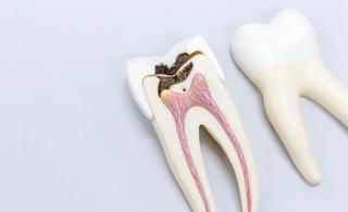 Why Choose DentalCare Carnegie? - Root Canal