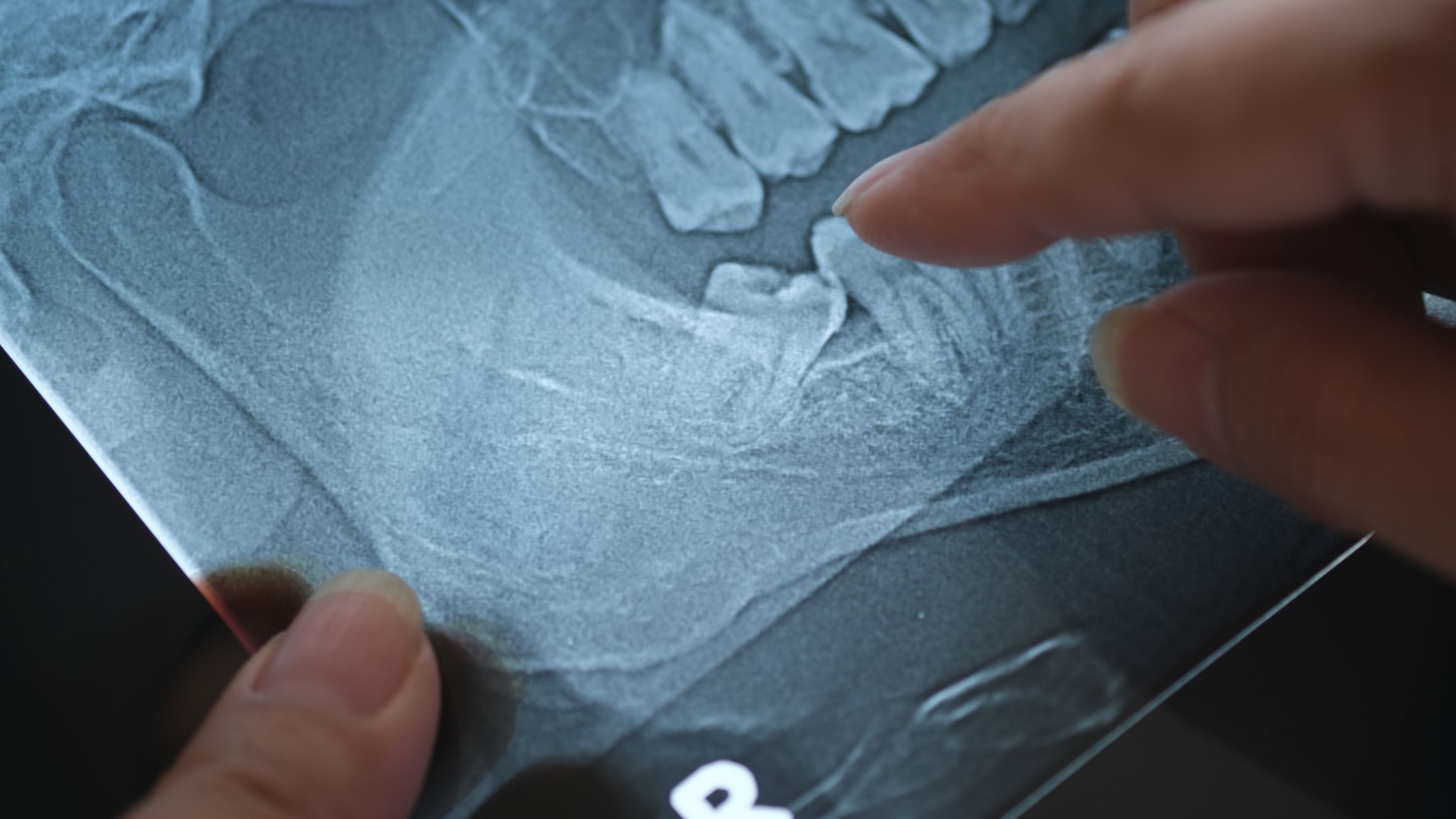 What are wisdom teeth?