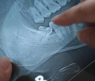 What are wisdom teeth?