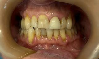 Trevor before crown and bridge treatment.