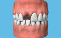 Restoring missing teeth or gaps using a single tooth, fixed and permanent dental implant