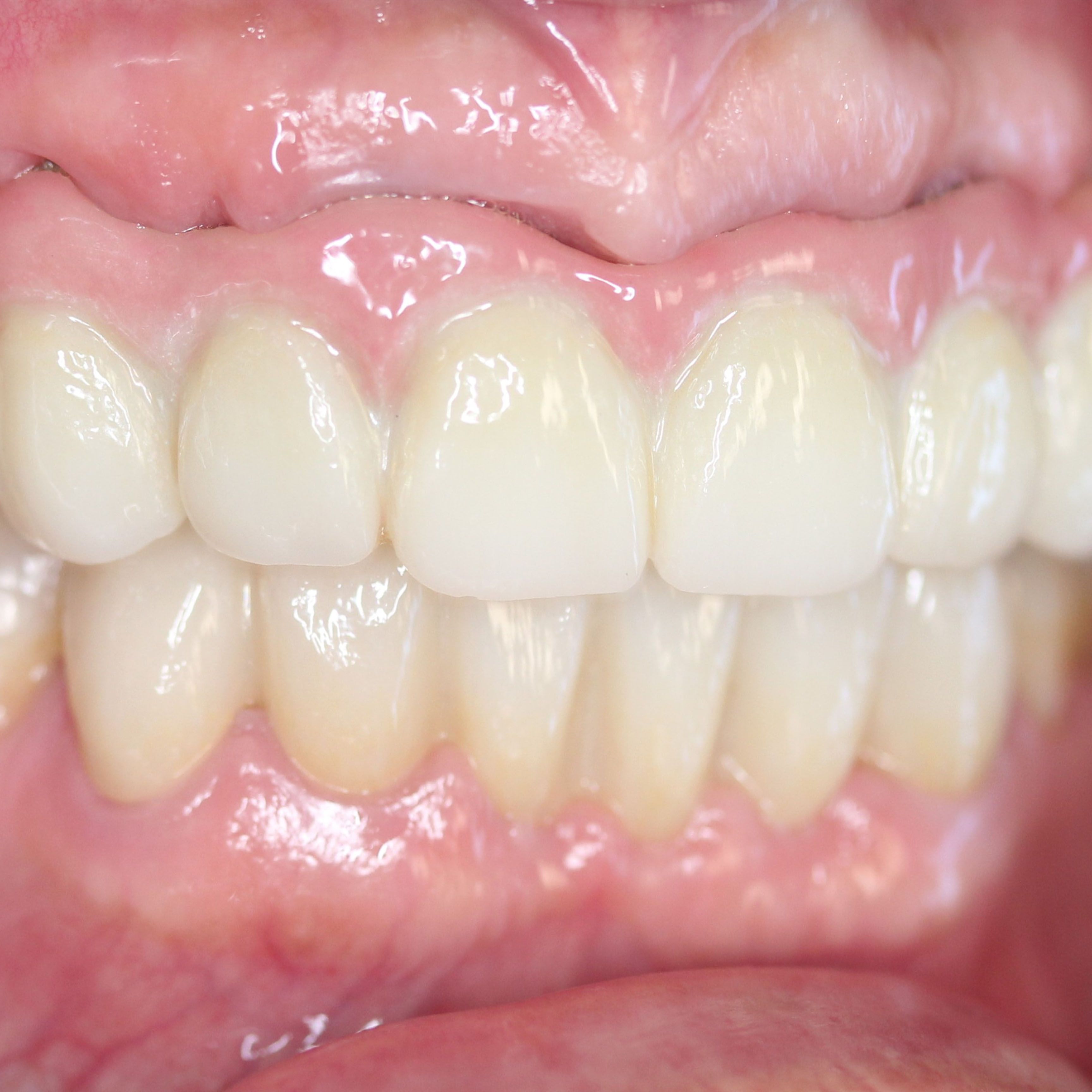 Porcelain Veneers After