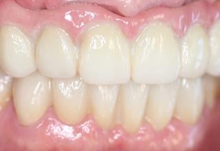 Porcelain Veneers After