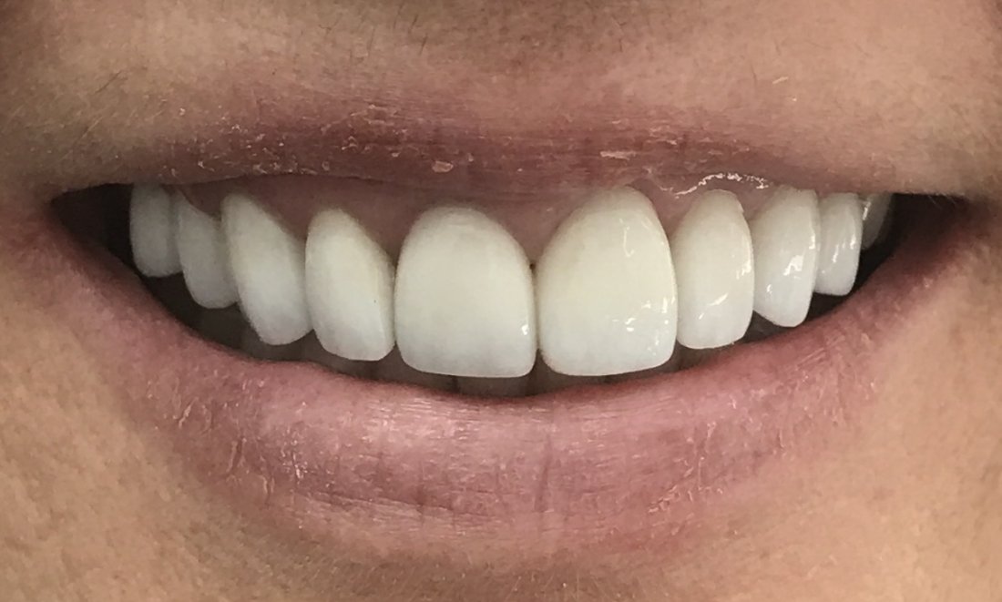 Veneers - After
