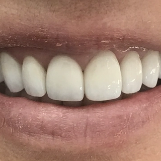 Veneers - After