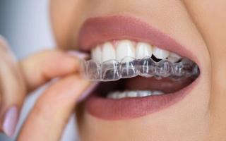 Comparing Invisalign vs braces