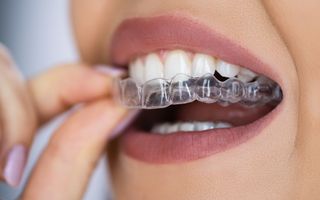 Invisalign retainers that are trusted by millions.