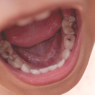 Why Children's Dental Health Matters?
