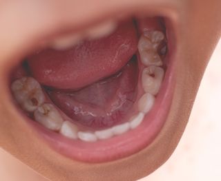 Dental Decay
