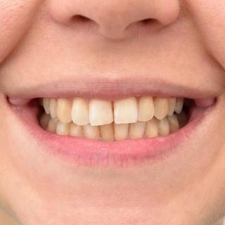 What Results Can I Expect?