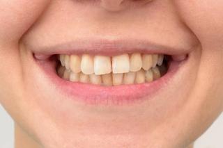 Discoloured Tooth