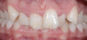 Teeth before & after Invsialign 