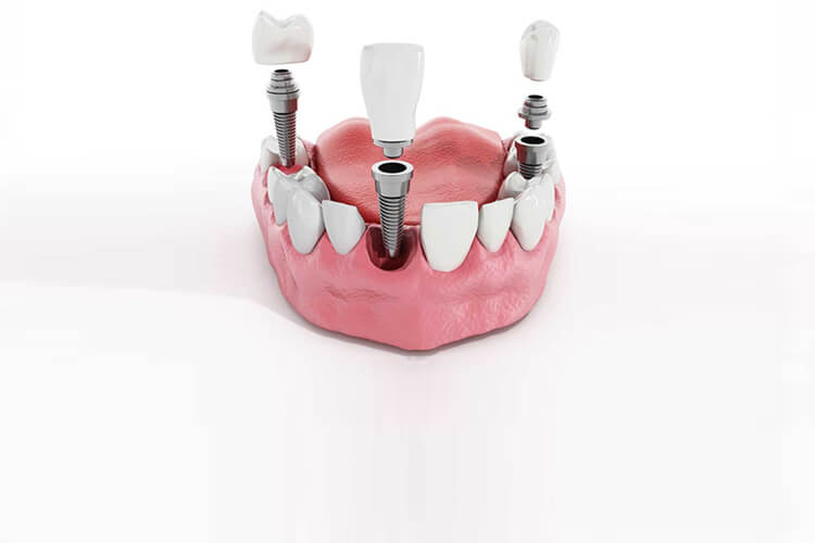 3D dental implant model