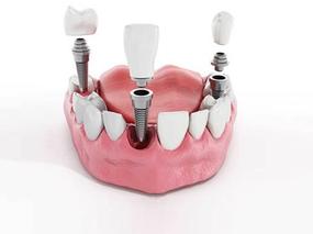 3D dental implant model