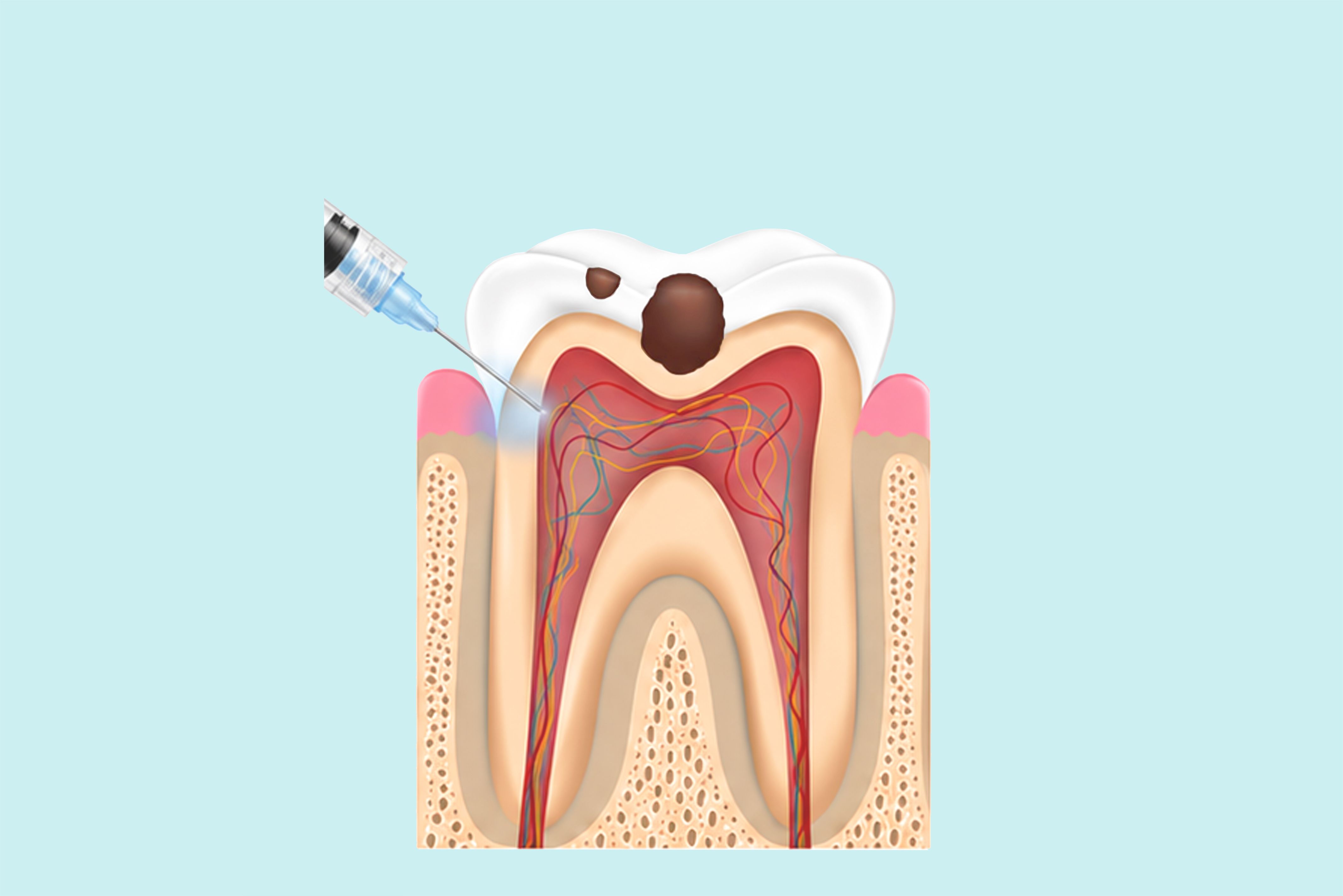 Step 1 — Numbing the area