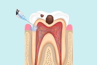 Step 1 — Numbing the area