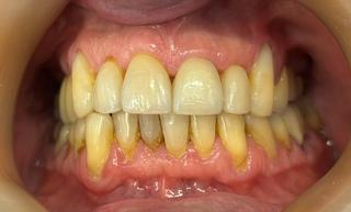 Trevor after crown and bridge treatment.