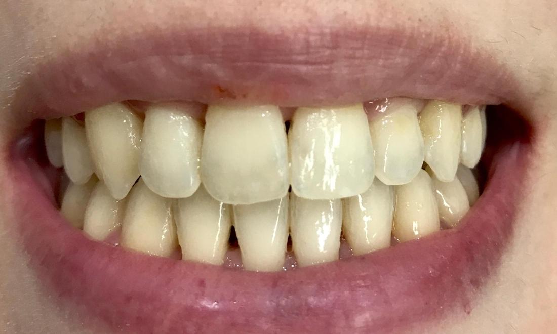 Cosmetic Dentistry - Before
