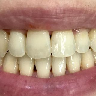 Cosmetic Dentistry - Before