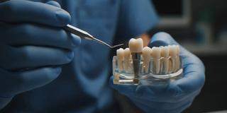 Options for Lost Teeth: Implants, Bridges & Dentures - Hero