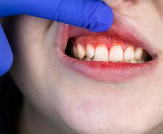 Abscess