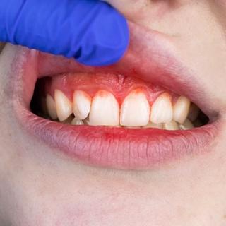 Severe toothache