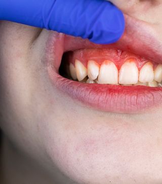 Gum Disease Treatment - Hero