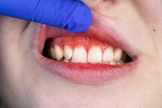 Gum disease