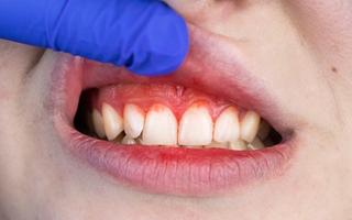 Gum Disease Treatment