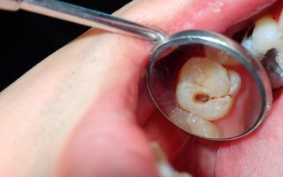 What to do if you have tooth decay!