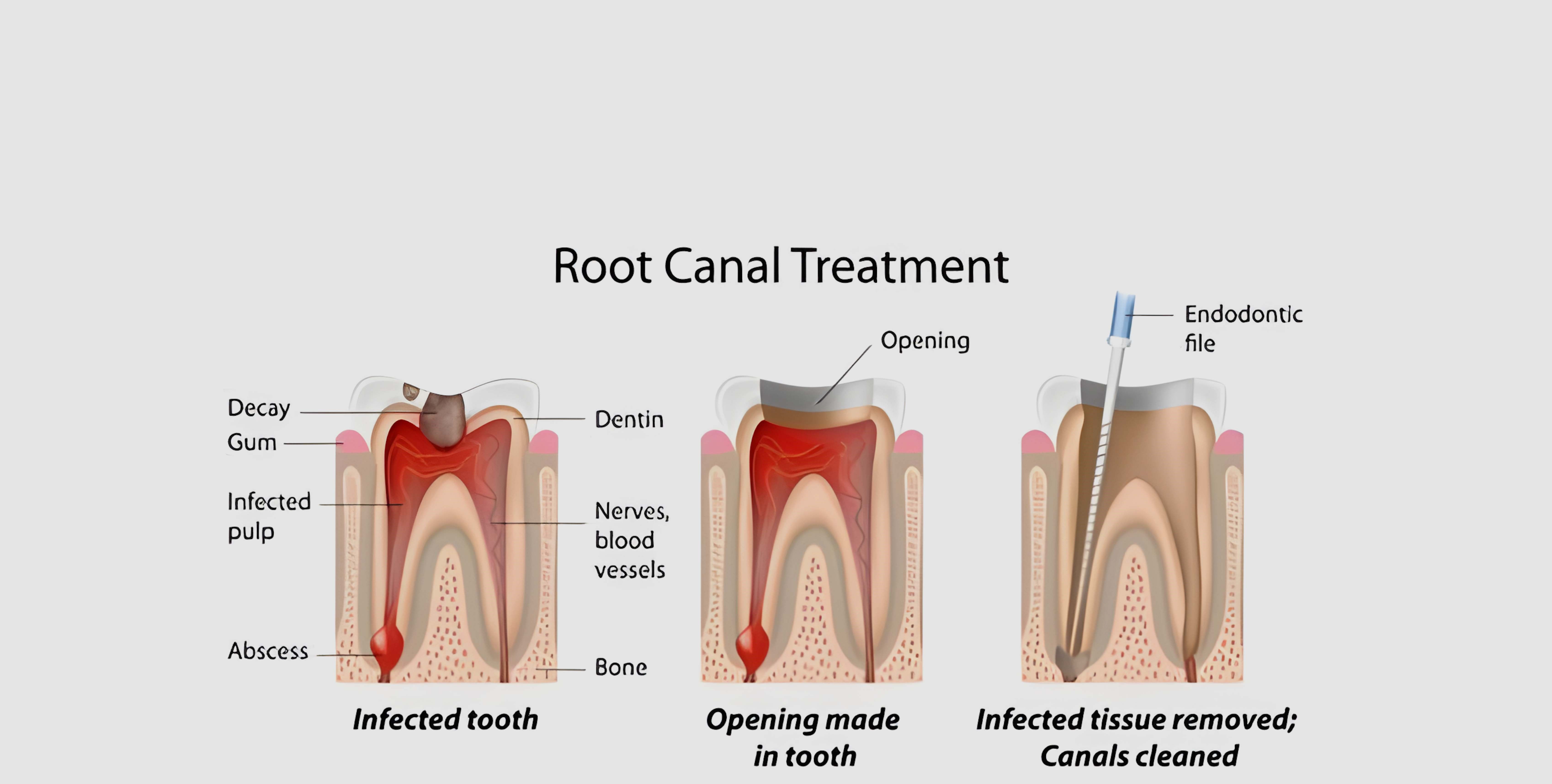 What to Expect during the Root Canal Procedure? 1