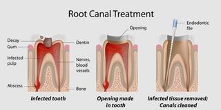 What to Expect during the Root Canal Procedure? 1