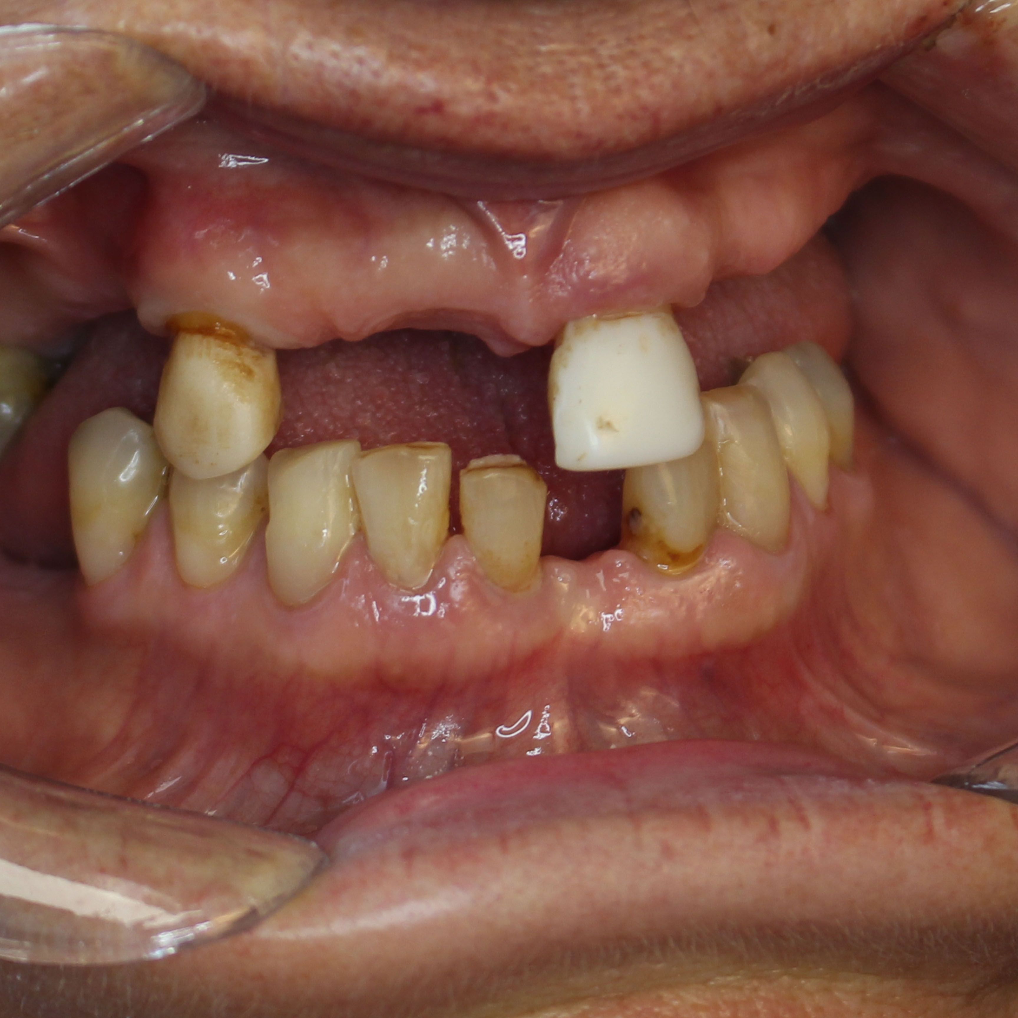 Porcelain Veneers Before