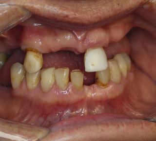 Porcelain Veneers Before