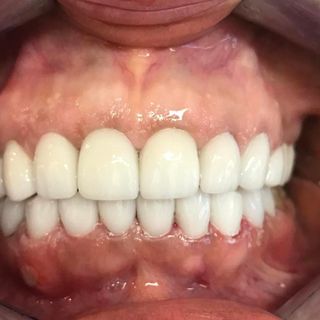 Cosmetic Dentistry - After