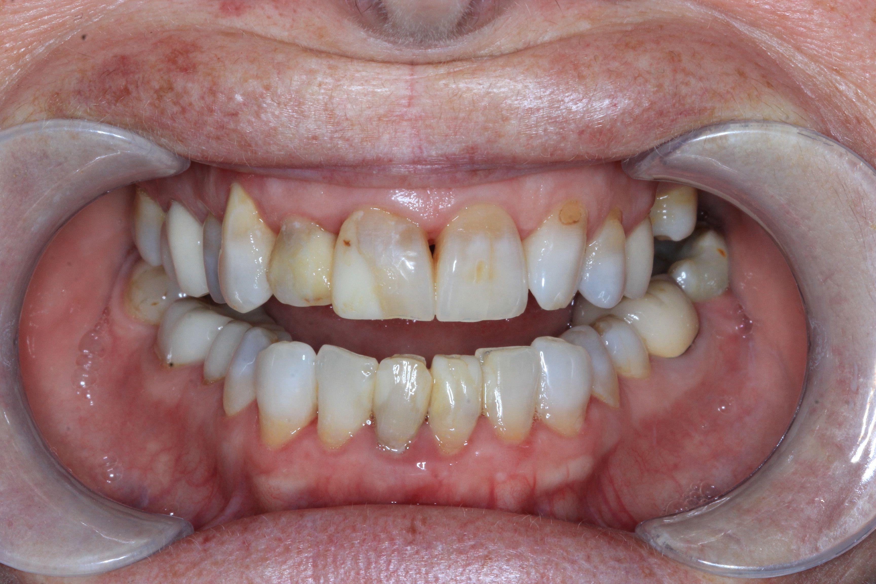 before dental crowns
